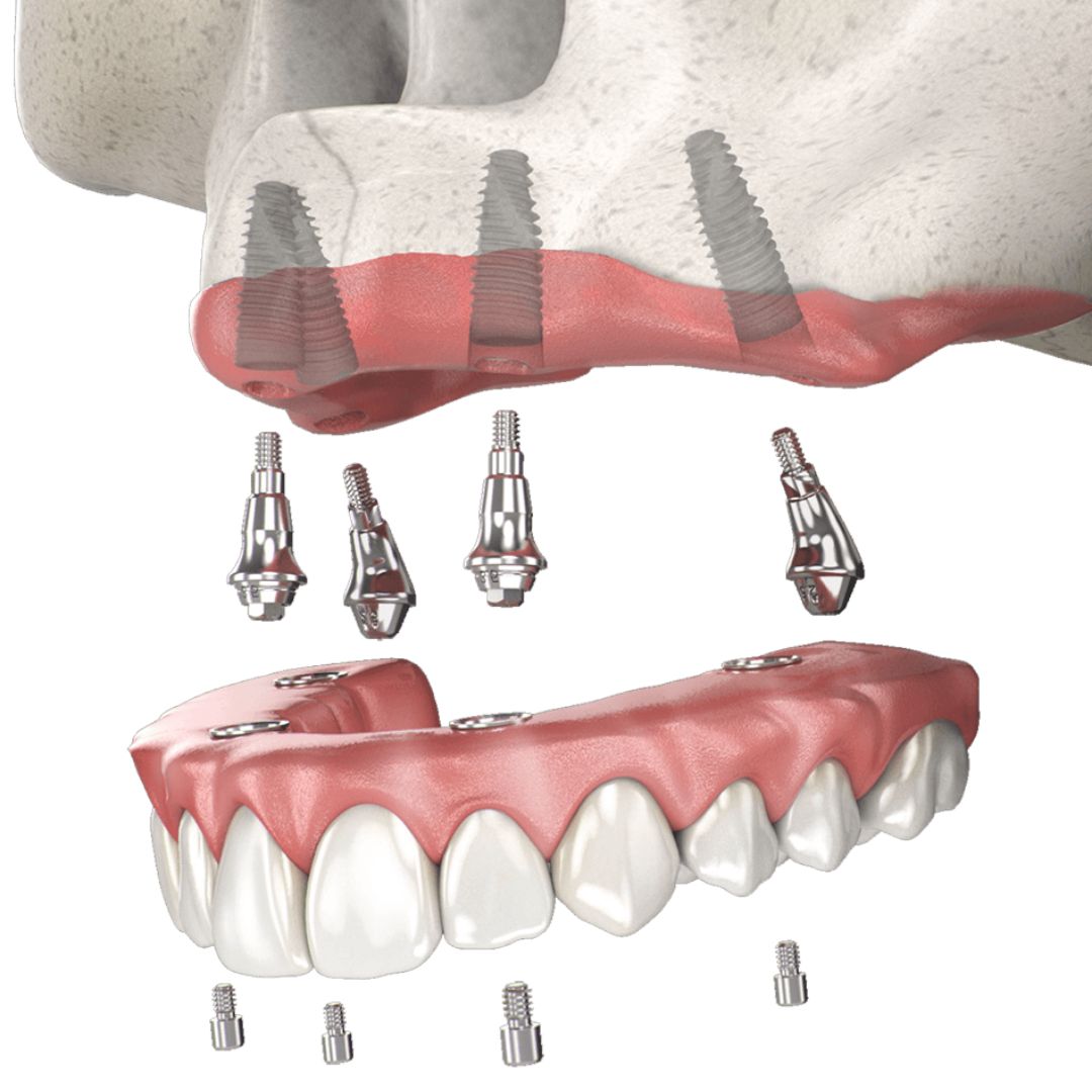 All-On-4 Implants