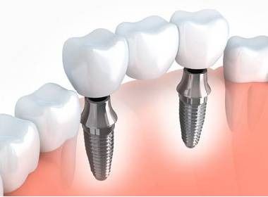 Basal Implants