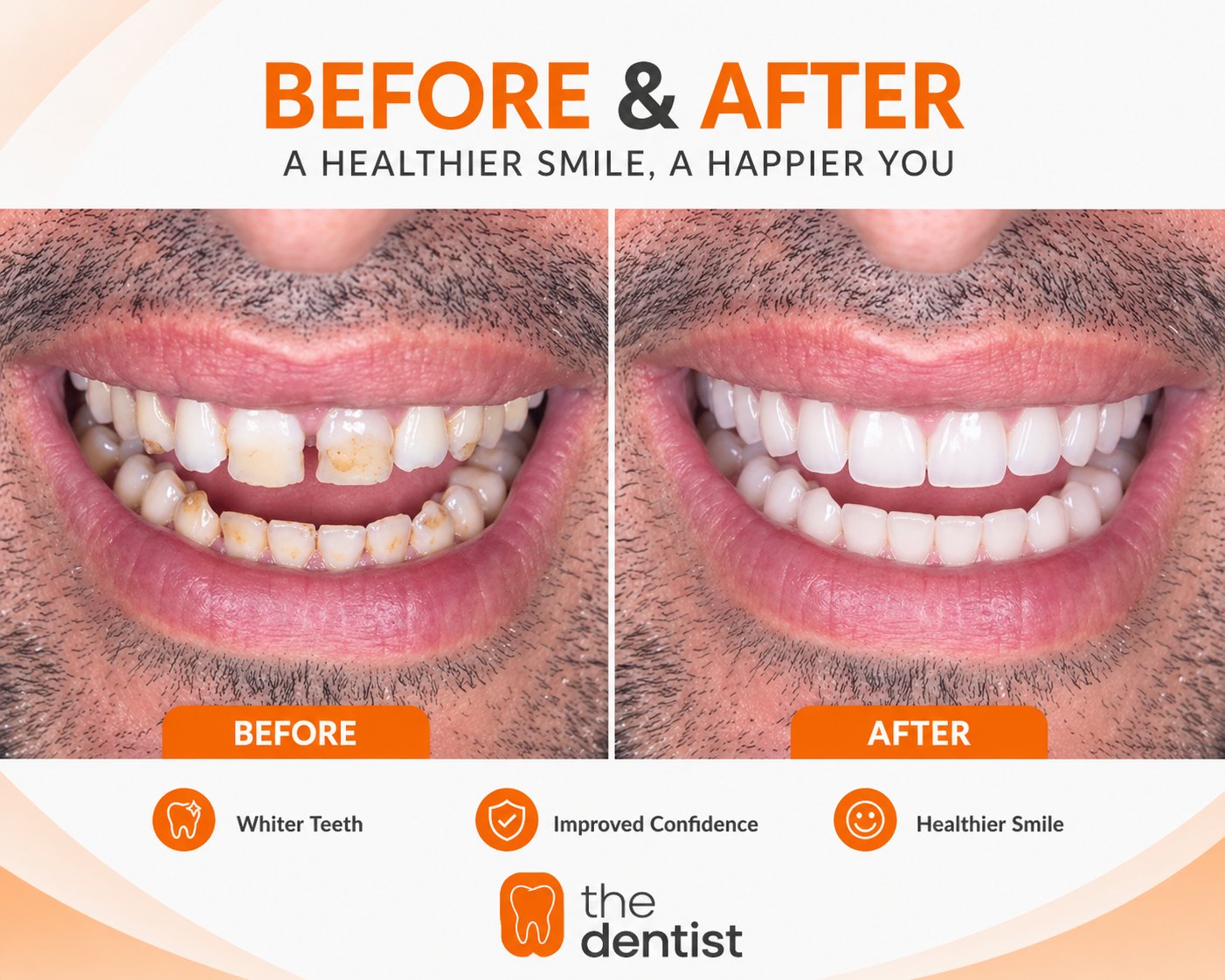 Full smile restoration before and after