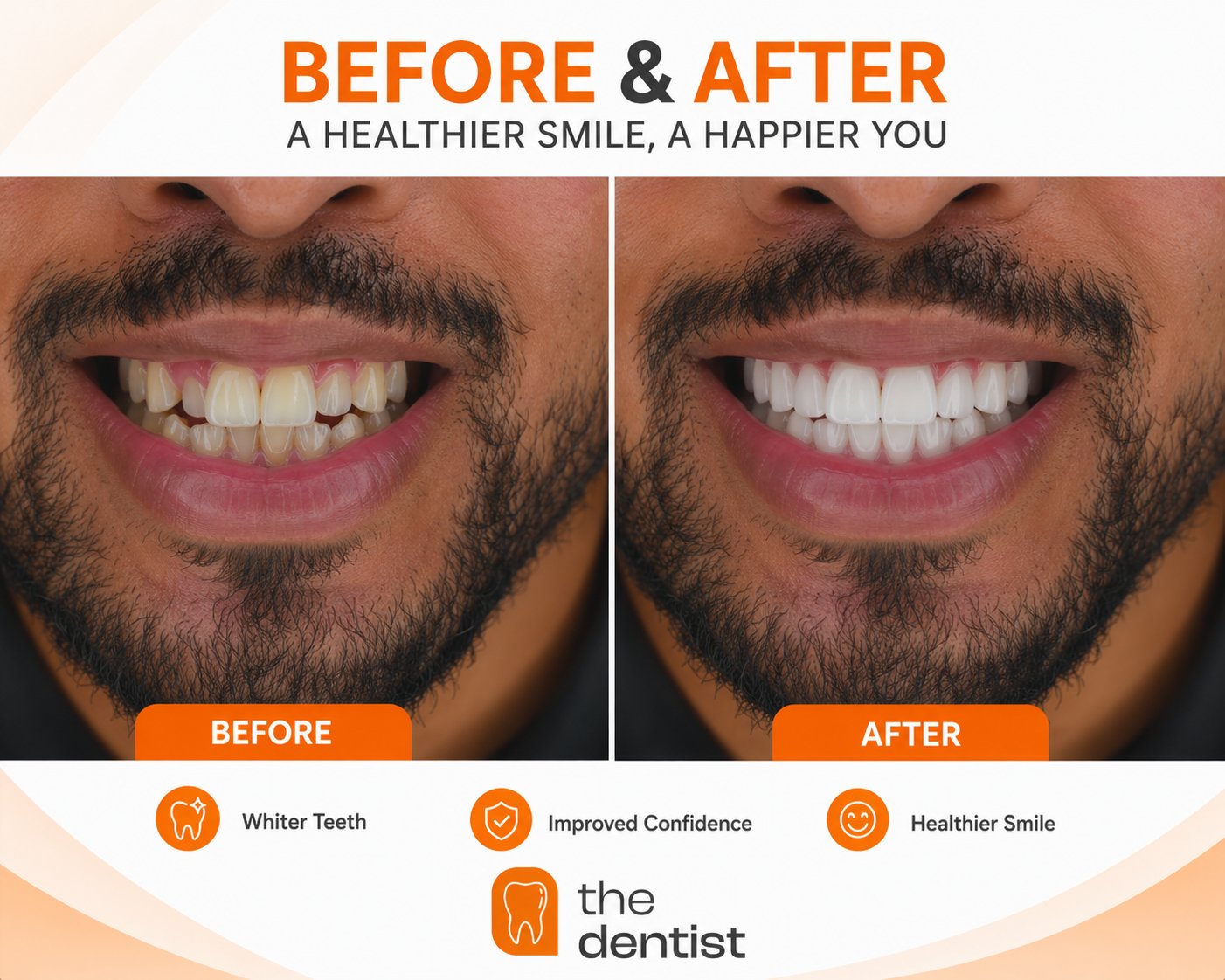 Professional teeth whitening results