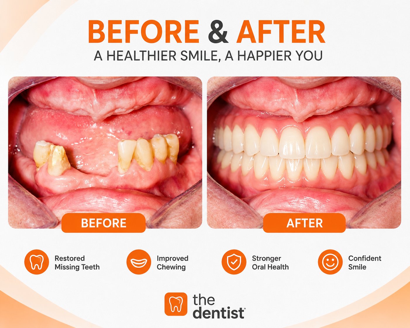 Full mouth restoration with dental implants before and after