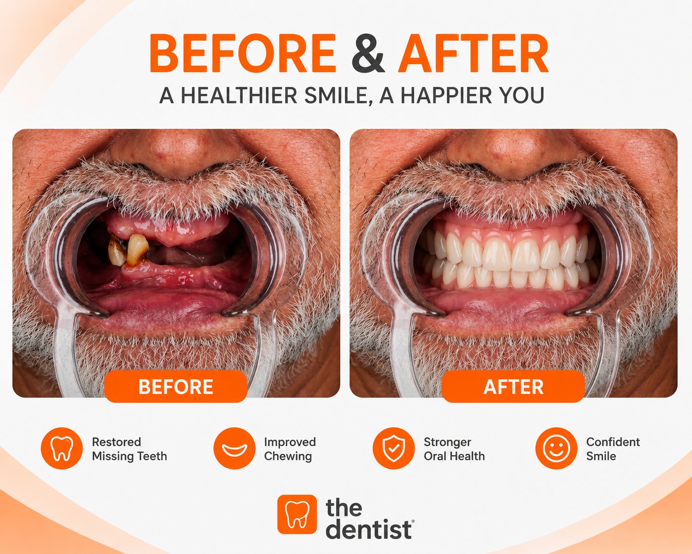 Complete dental rehabilitation before and after