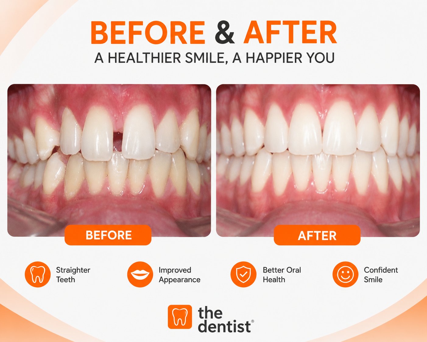 Teeth gap correction with braces before and after