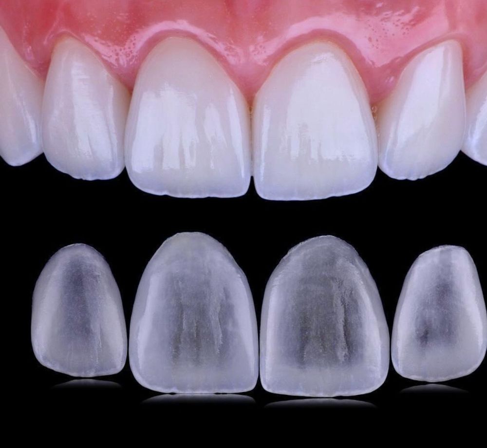 Dental Veneers