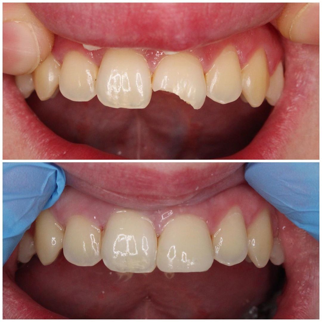 Fractured Tooth Restoration