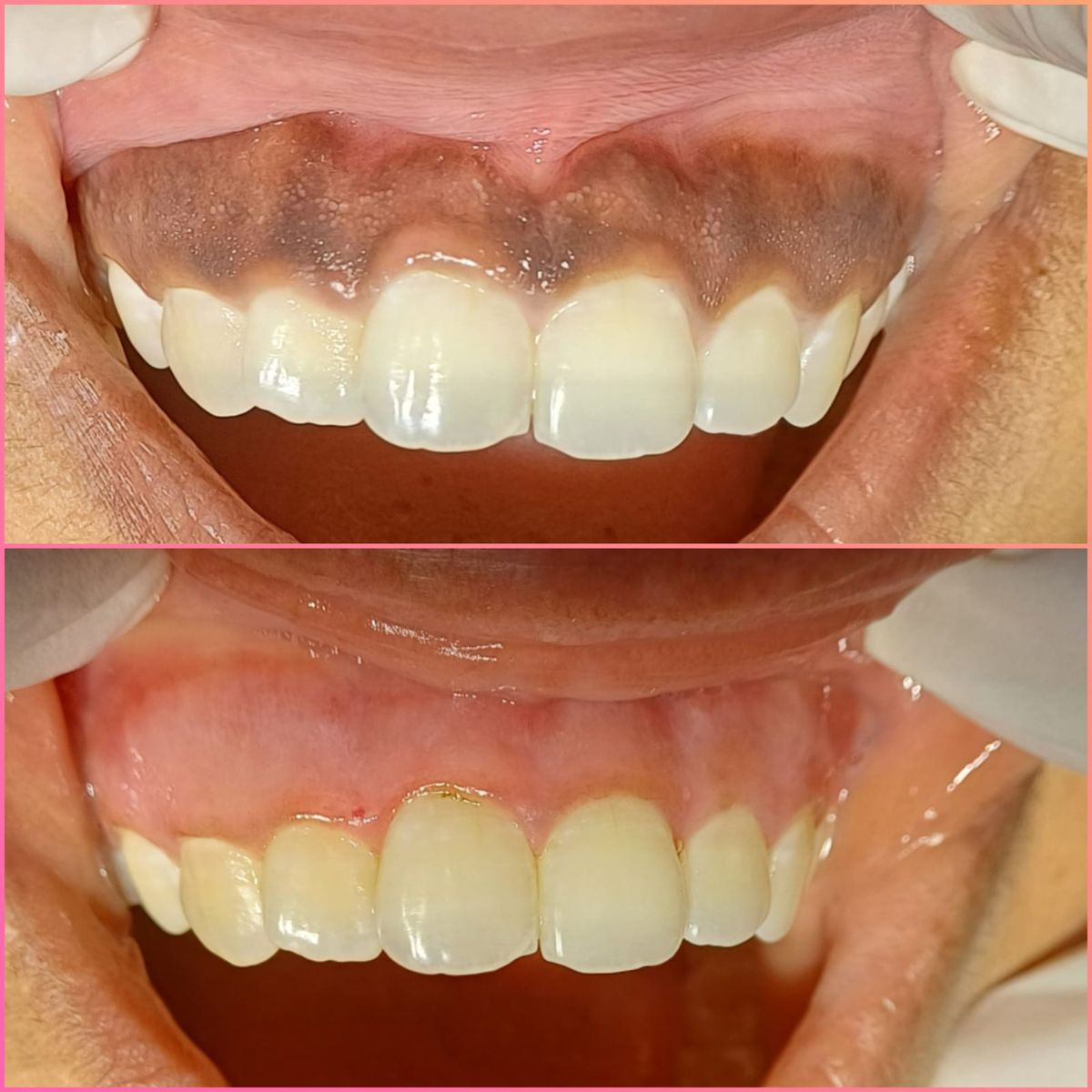 Gum Depigmentation