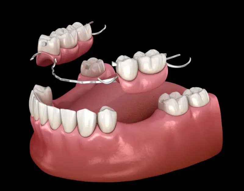 Immediate Implants