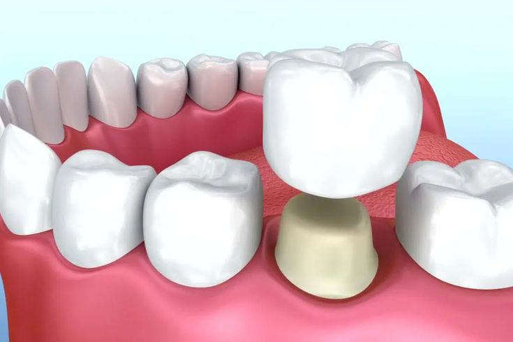 Metal Free Crowns and Bridges
