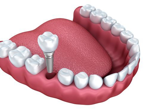 Single Stage Implants