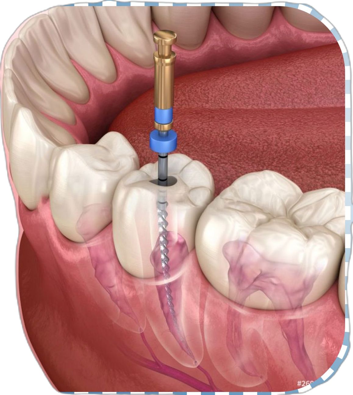 Single Visit Root Canal