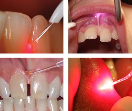 Soft Tissue Lasers