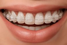 Ceramic Orthodontic Braces