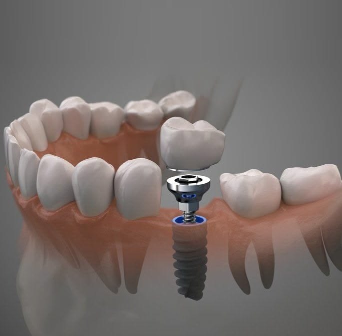 Two-Stage Implants