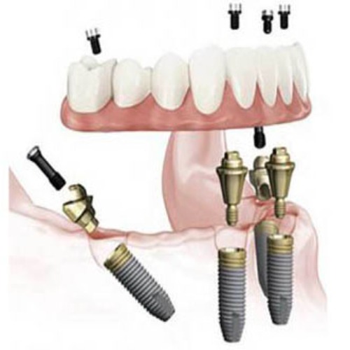 dental implants near me