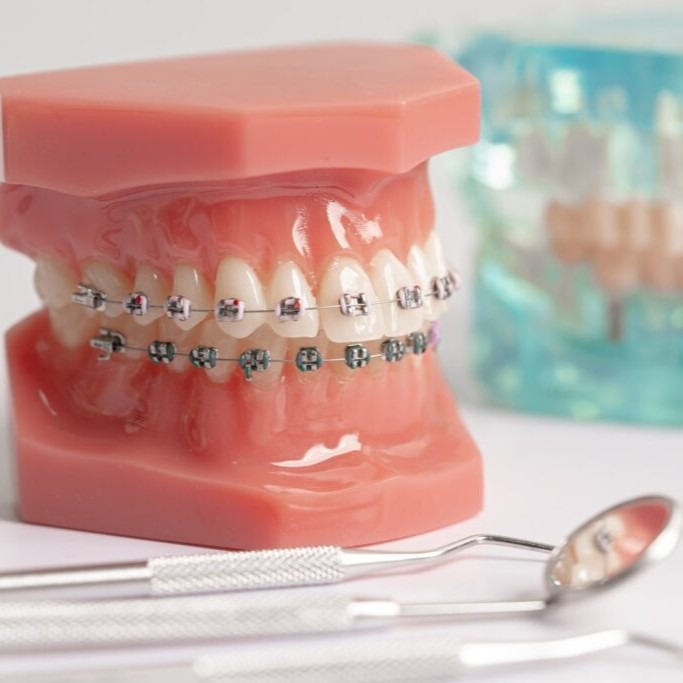 braces for teeth near me