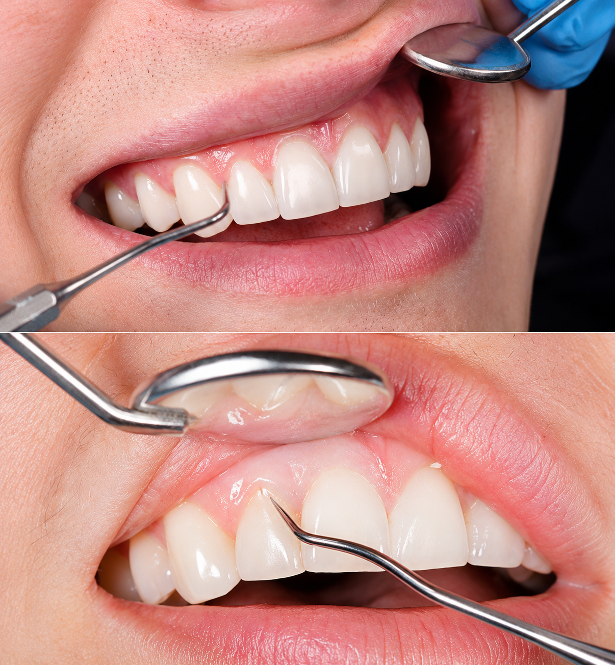 What is Gum Treatment ?