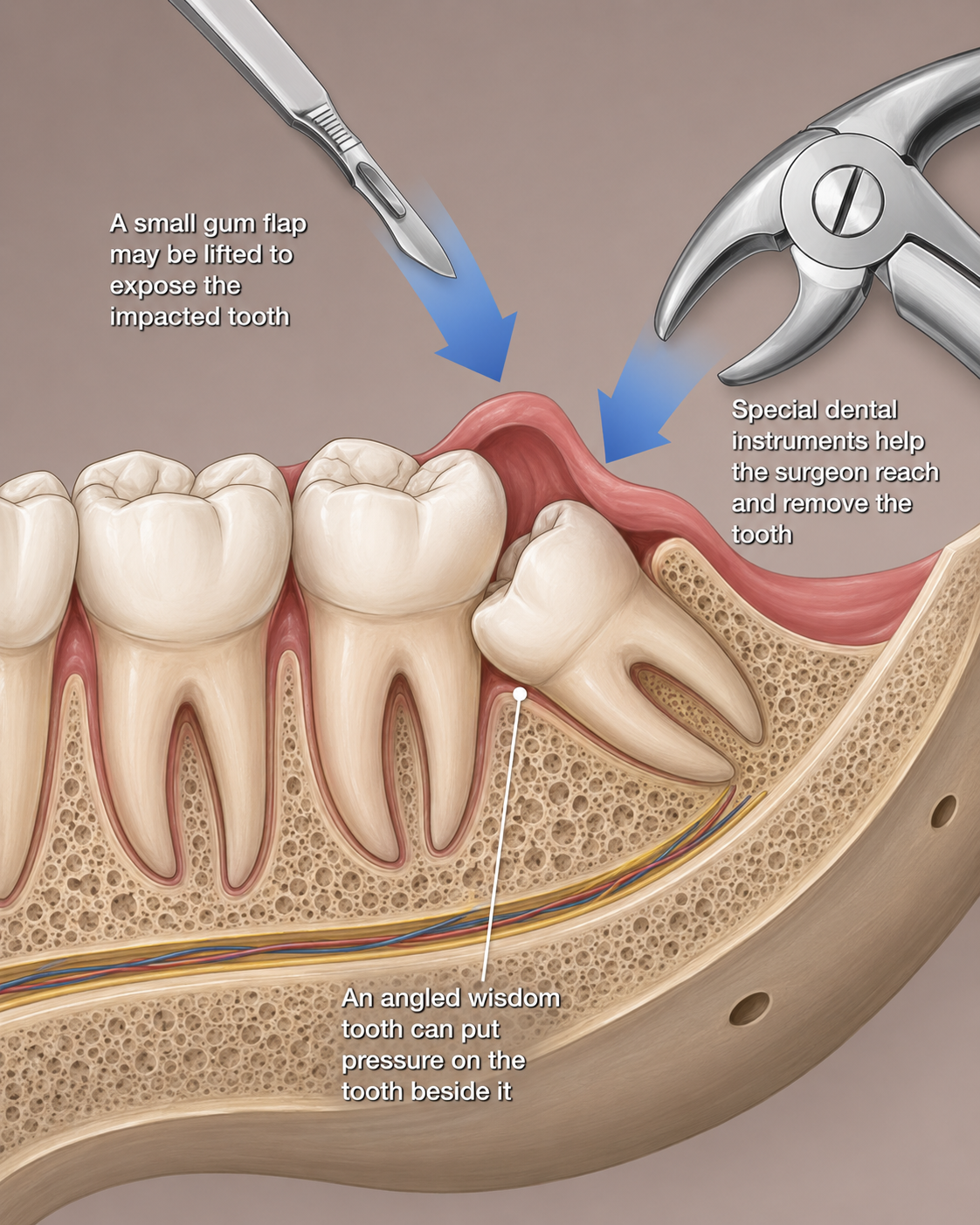 Why is Wisdom Teeth Removal Important?