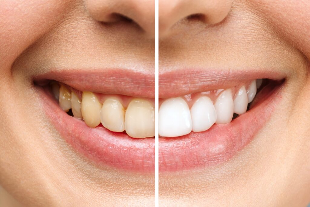 Teeth Whitening