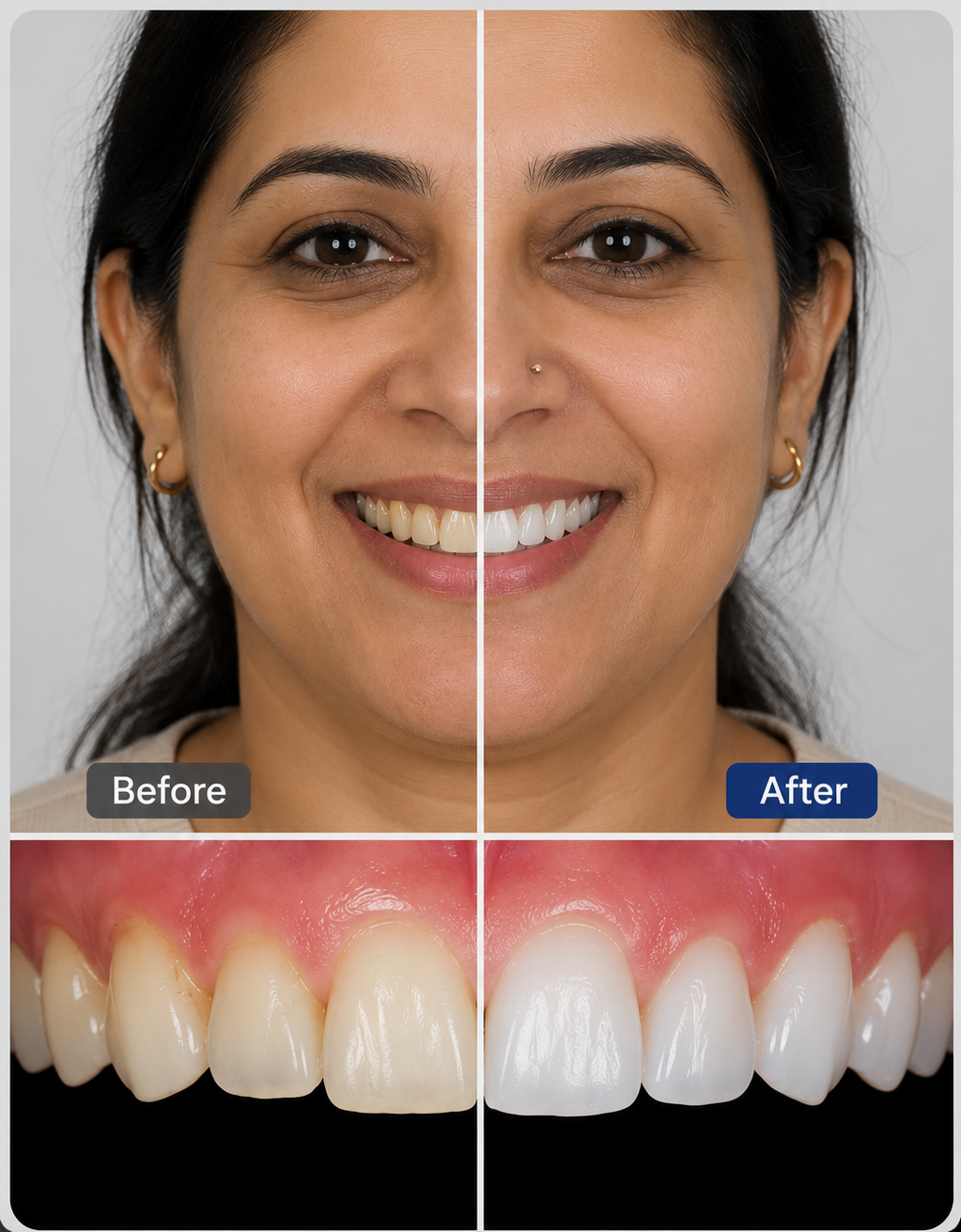 A Personalised Teeth Whitening Plan That Transformed the Patient's Smile