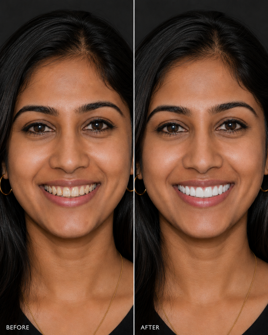 Transform Your Smile with Custom Veneers & Smile Designing
