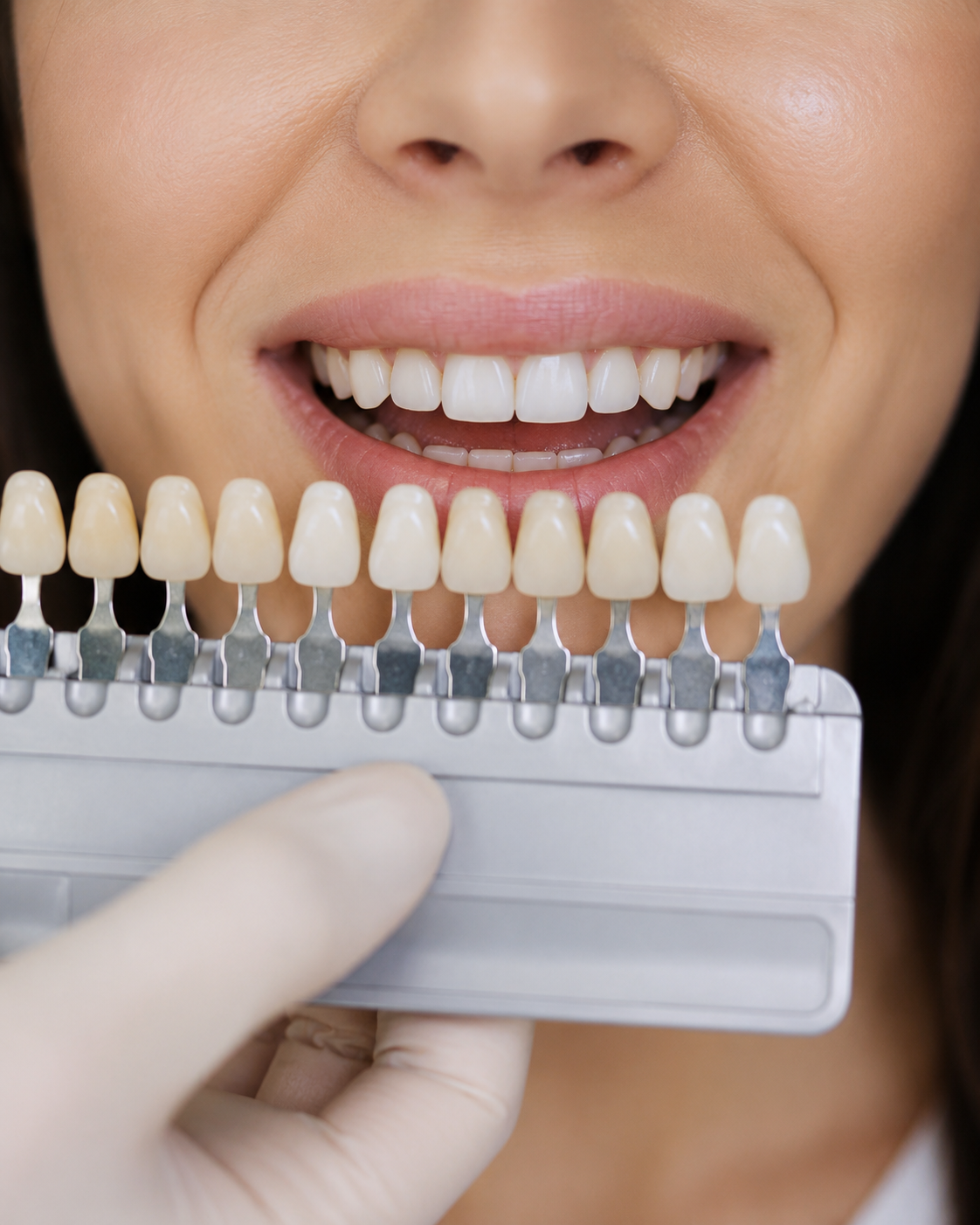 What Are Tooth-Coloured Crowns & Which Crown Is Right for You?