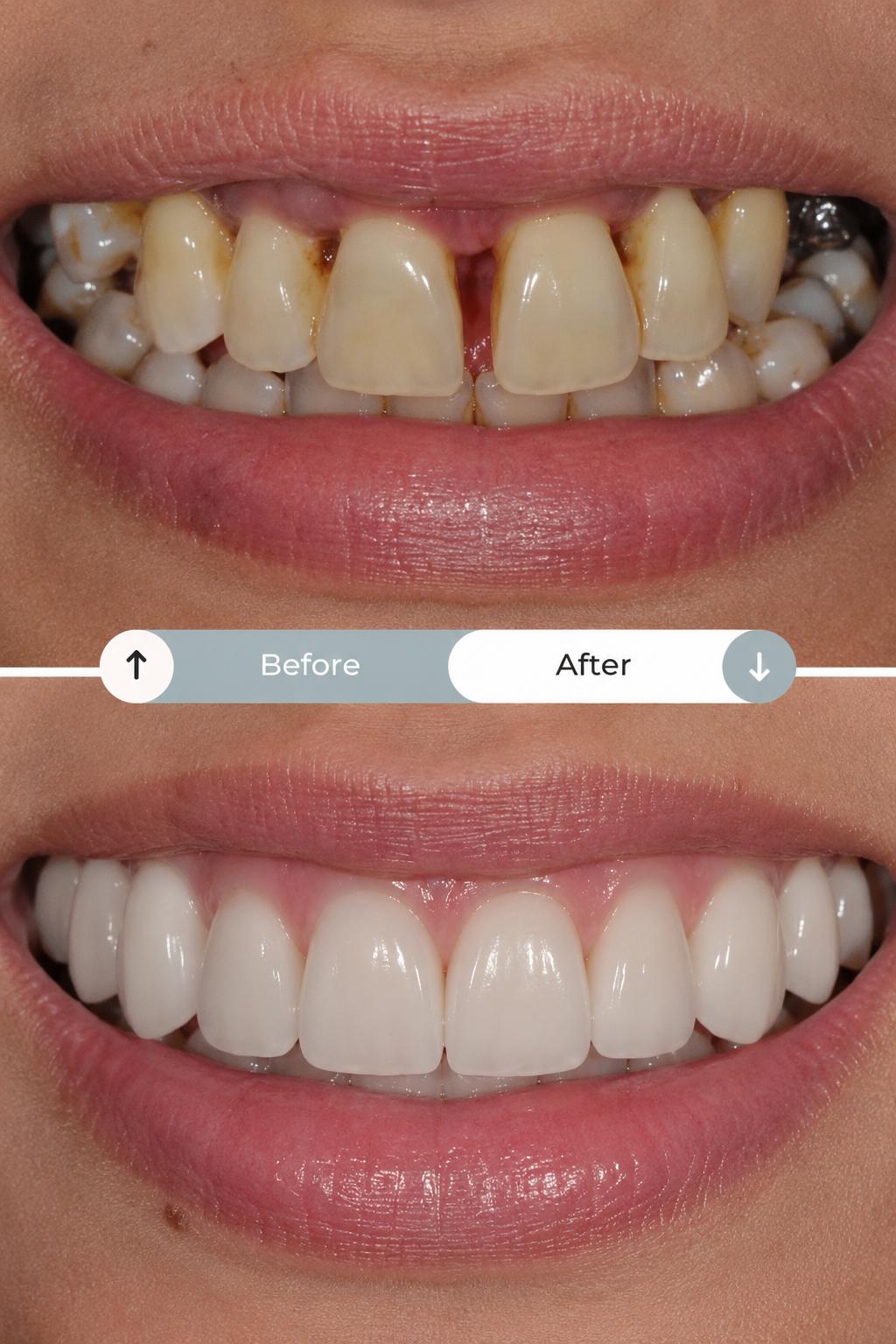 What Is Gap Closure & Which Treatment Is Right for You?