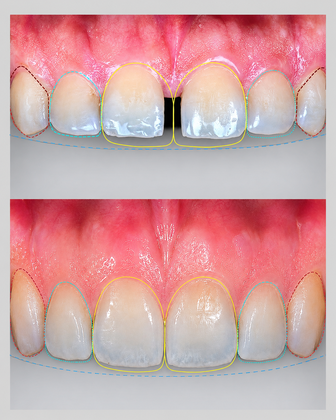 Natural-Looking Gap Closure for a Confident Smile