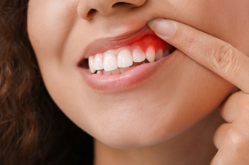 gum-3 gum-3